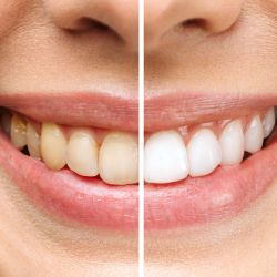 Bleaching Darmstadt | Bleaching Dreieich - Zahnärzte Jahn und Kollegen